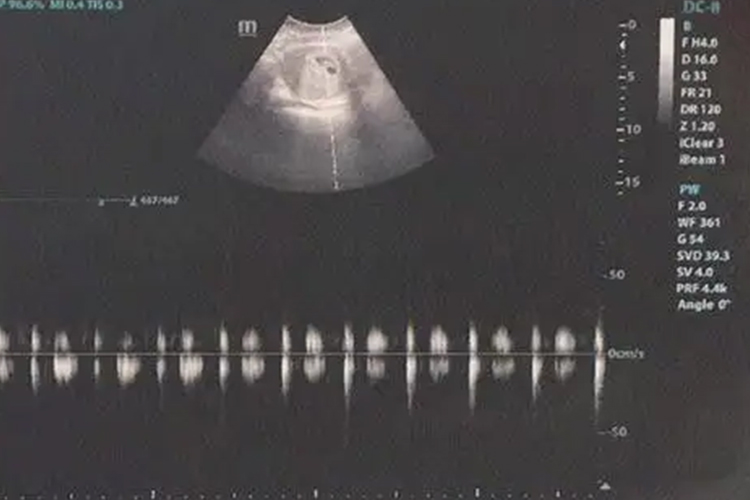 怀孕40天原始心管搏动超声图