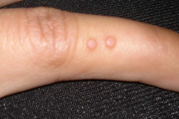 孩子手指上寻常疣图