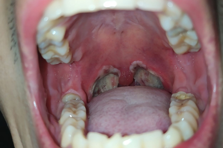 术后24小时覆盖白膜图 术后24小时覆盖白膜图