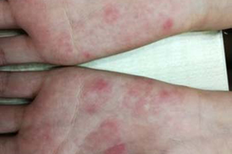 艾滋病期手掌症状图