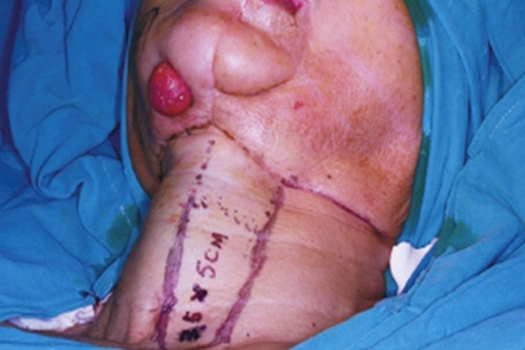 头部鳞状细胞癌下巴症状图