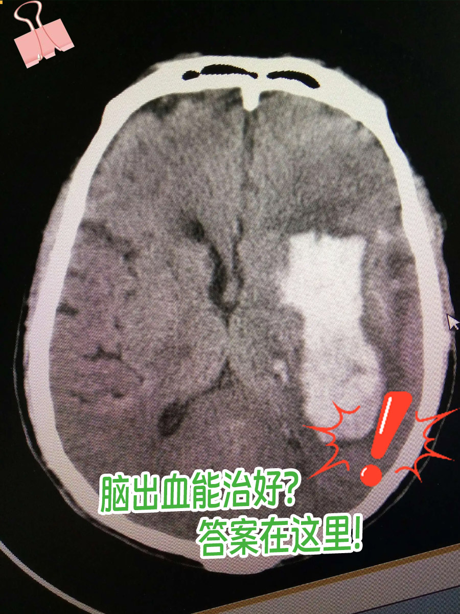 脑出血能治好吗?答案在这里!