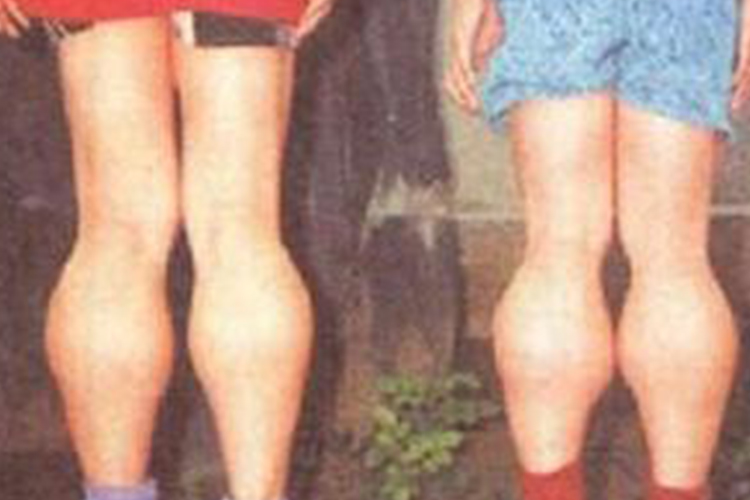 假肥大型肌营养不良图