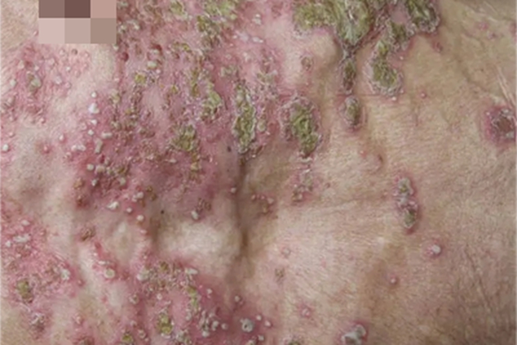 皮肤蝇蛆病胸部症状图