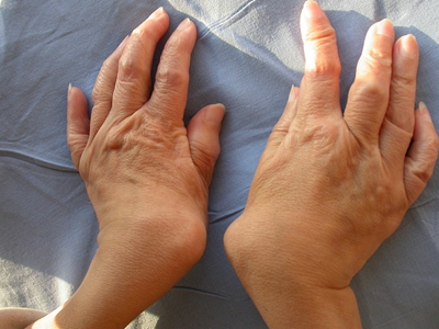 手指类风湿性关节炎的症状和图片 