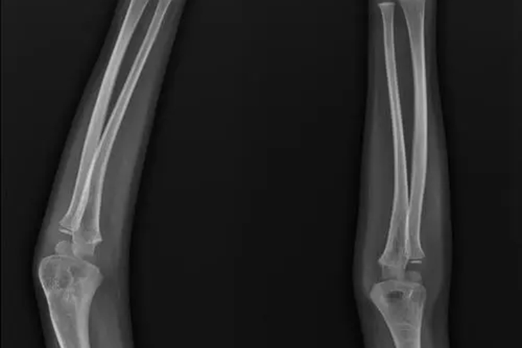 手肘外翻X线图 手肘外翻X线图
