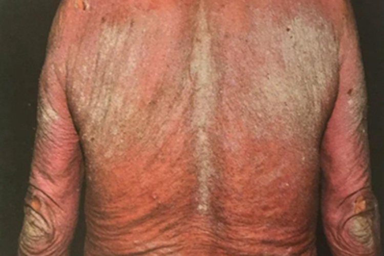 结痂性疥疮背部黄痂图