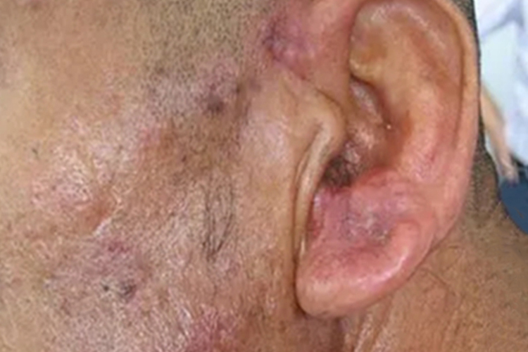 球孢子菌病耳周红斑图 球孢子菌病耳周红斑图