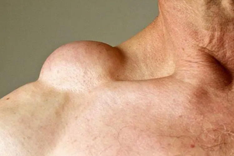 脂肪瘤肩膀上出现一个大包图