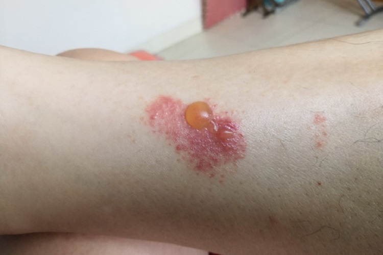 虫咬皮炎小腿大水疱图 虫咬皮炎小腿大水疱图