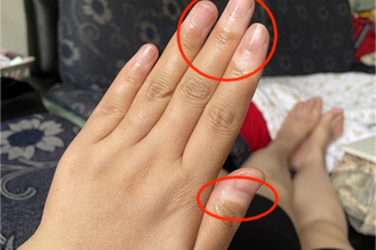 非节段型白癜风手指尖症状图