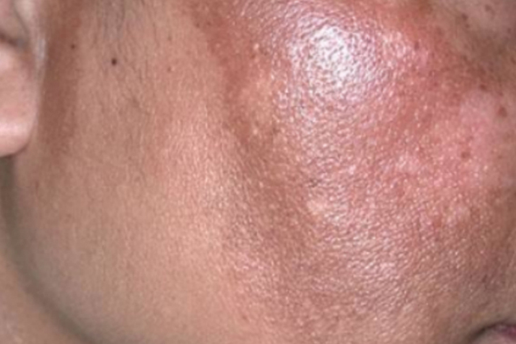 乙肝脸上长斑图