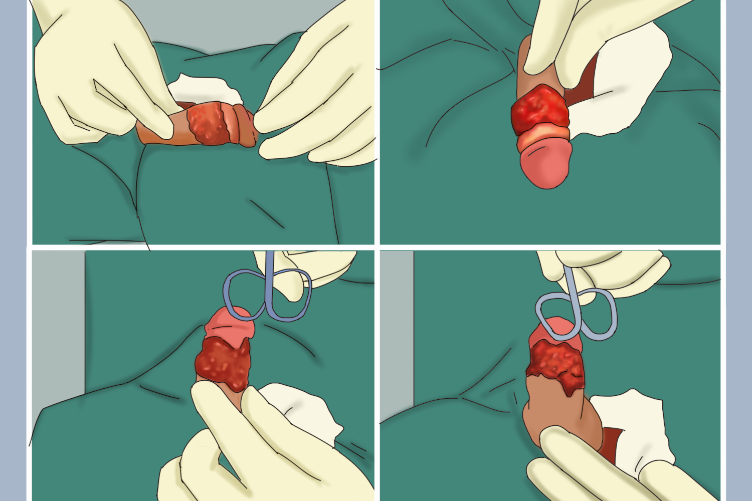包皮内外板皮肤环形切除术图
