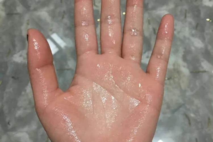 手汗症手部大量出汗图