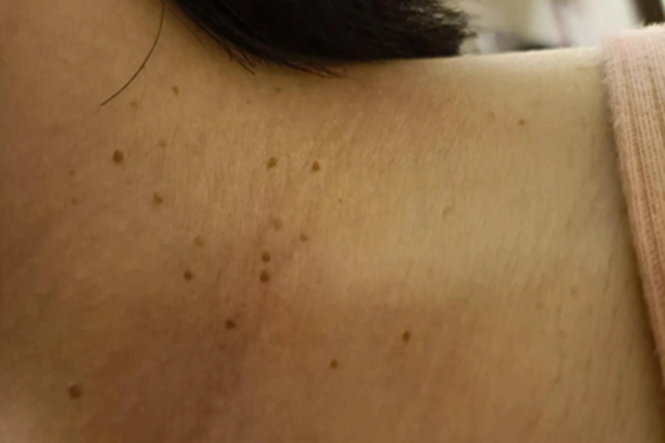 网状肢端色素沉着颈部有斑点图