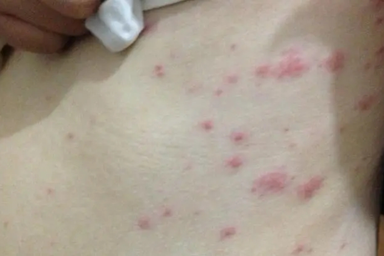 腰部湿疹红疹瘙痒图