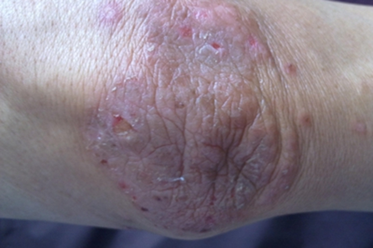 局限性神经性皮炎肘部红斑图