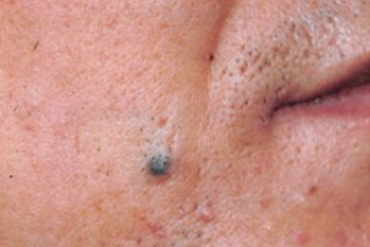 黑素细胞痣口周黑痣图