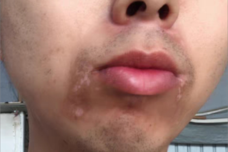 进展期节段型白癜风口周斑图