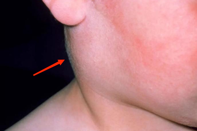 脖子长榨菜疙瘩图