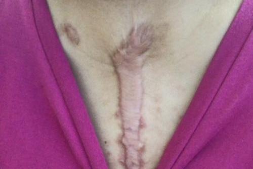 心脏搭桥手术瘢痕图 心脏搭桥手术瘢痕图