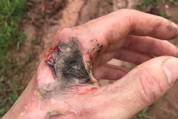 电烧伤手背脱皮图 电烧伤手背脱皮图