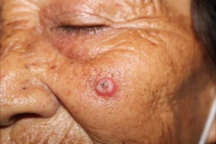 角化棘皮瘤面部丘疹图