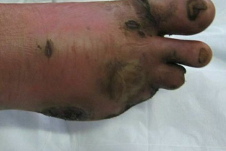 红斑性肢痛症脚部皮肤发黑图