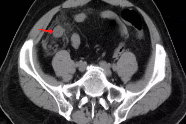 阑尾炎CT检查图