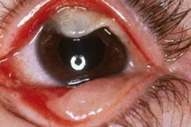 结膜乳头状瘤眼睑瘤图