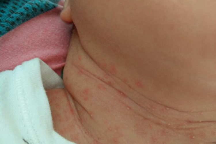 渗出型婴儿湿疹前颈小疙瘩图
