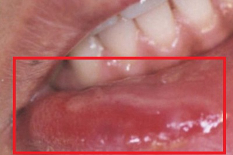 梅毒性唇下疳肿图 梅毒性唇下疳肿图