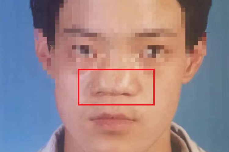 先天性鼻正中裂图 先天性鼻正中裂图