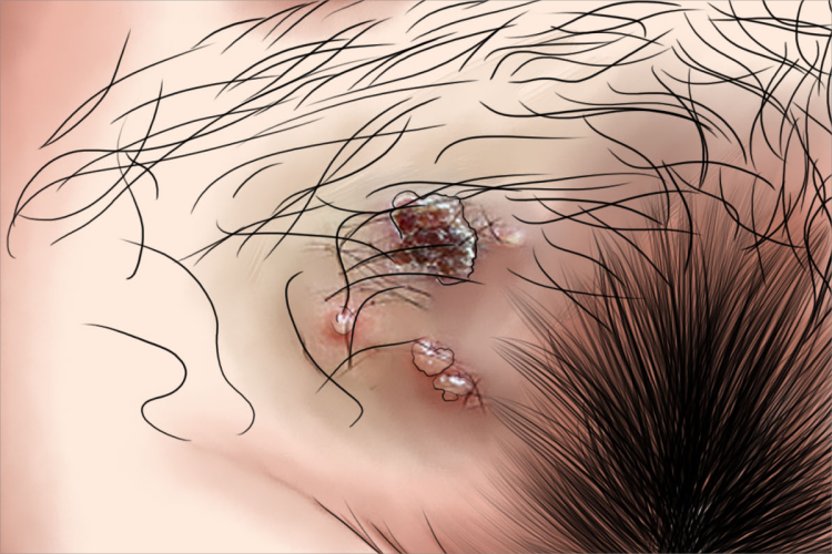 生殖器疱疹溃疡图