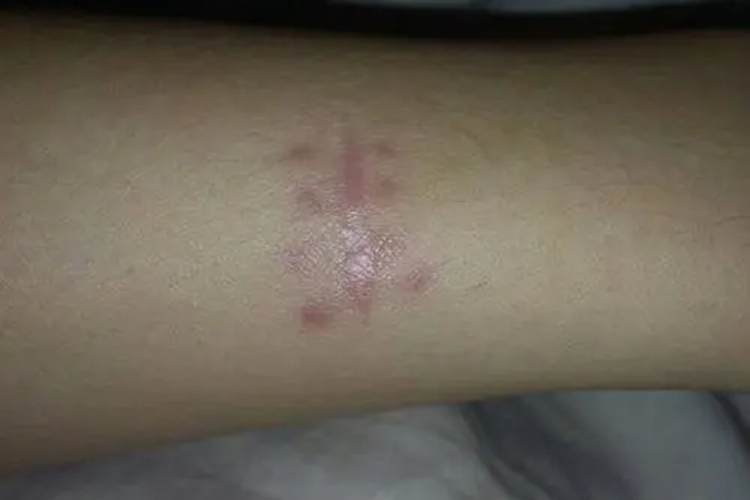 皮肤活检瘢痕图