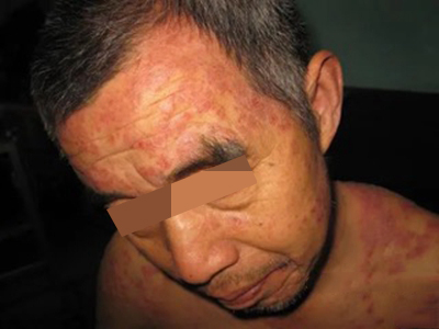 光化性痒疹前额好几片红色丘疹图.jpg