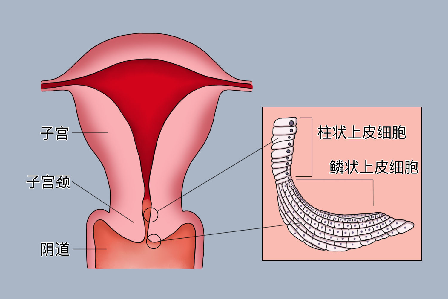宫颈癌好发部位图