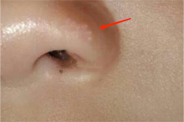 新生儿皮脂腺增生鼻翼症状图