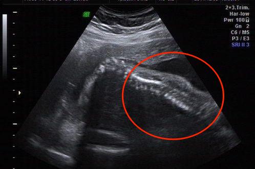 开放性神经管缺陷脊柱裂图