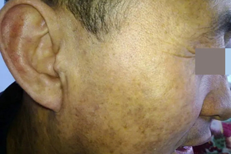 面颈部毛囊红斑黑变病黑斑图