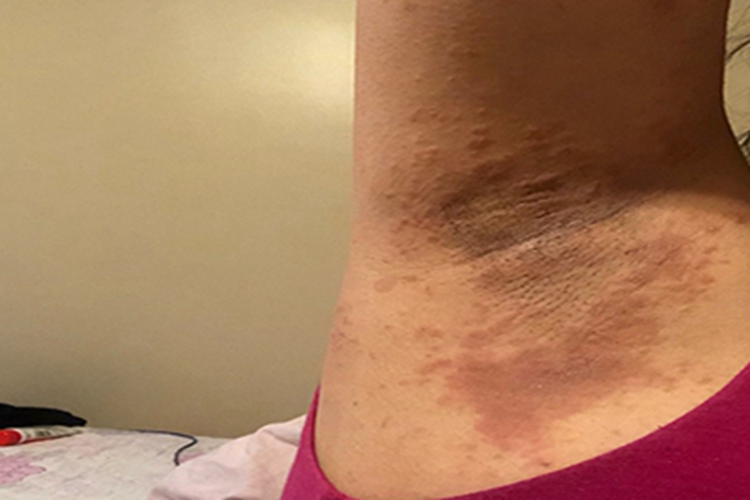 亚急性湿疹腋窝症状图