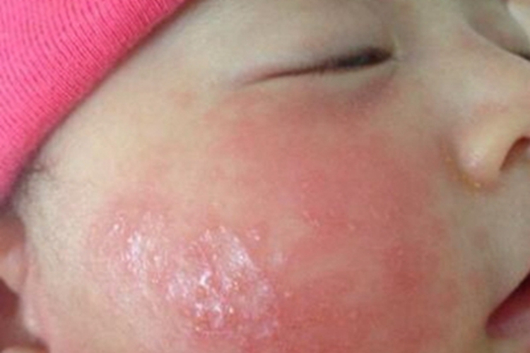 渗出型婴儿湿疹面部小疙瘩图