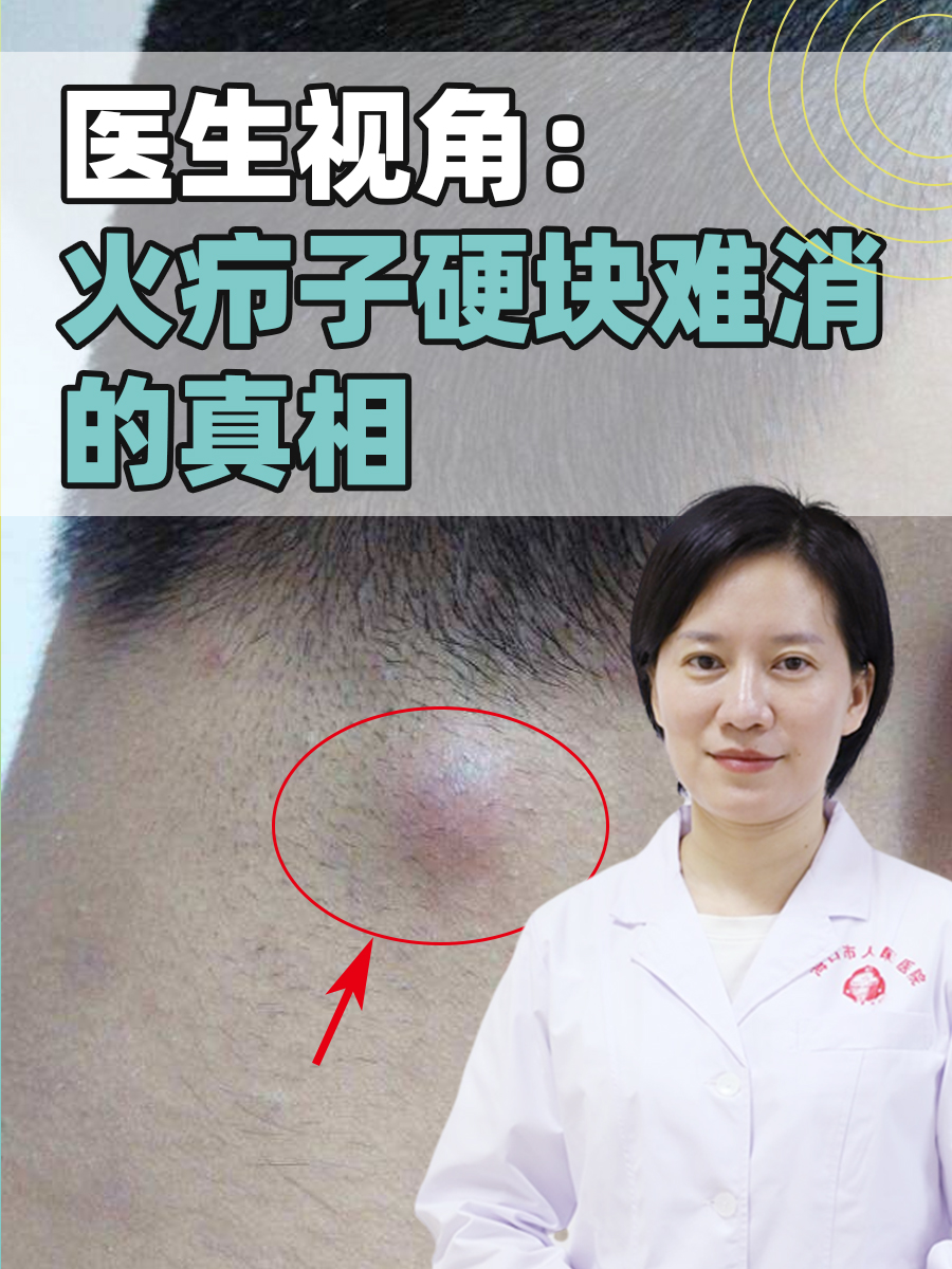 医生视角：火疖子硬块难消的真相