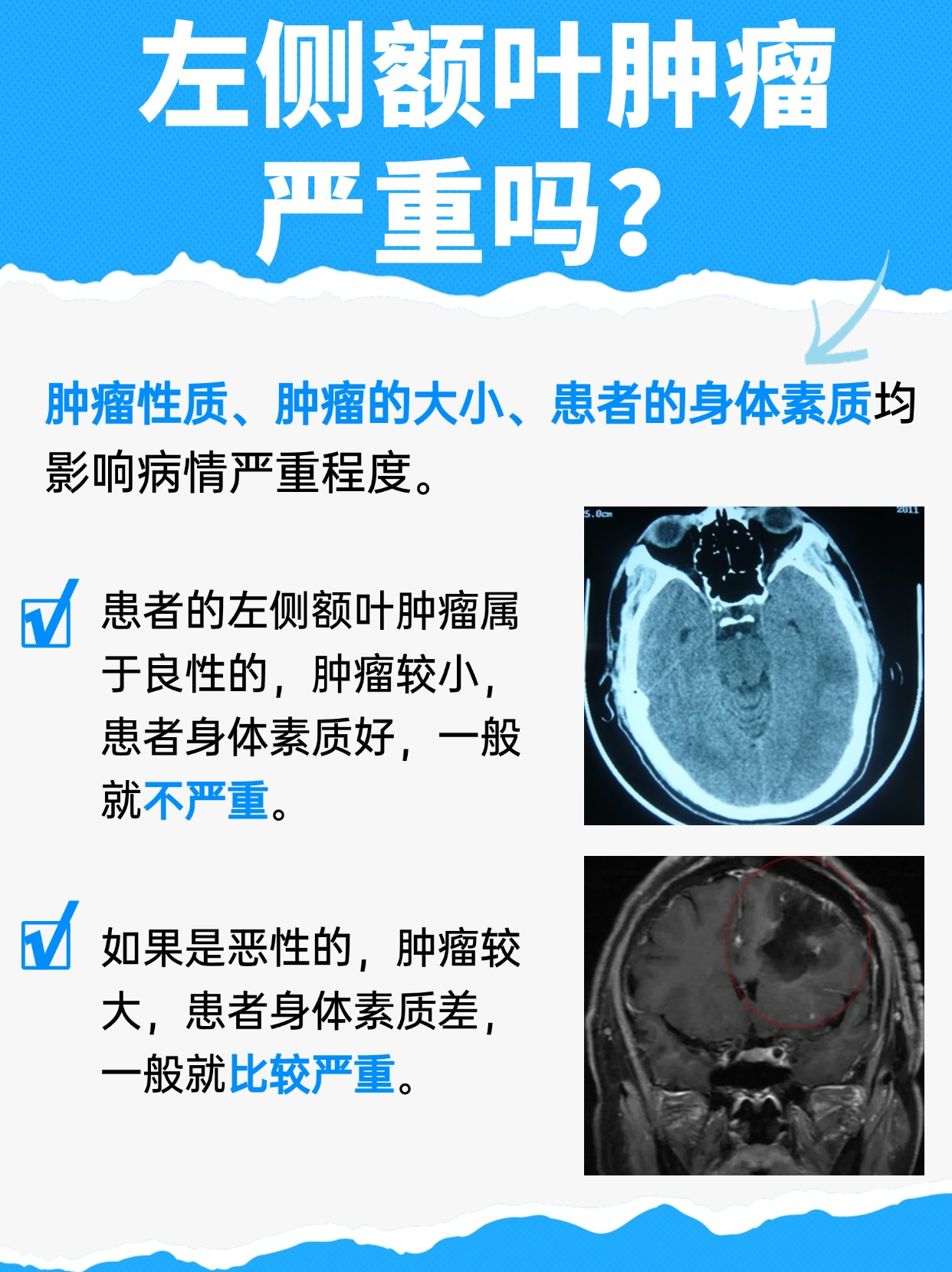 医生带你了解，左侧额叶肿瘤严重吗？