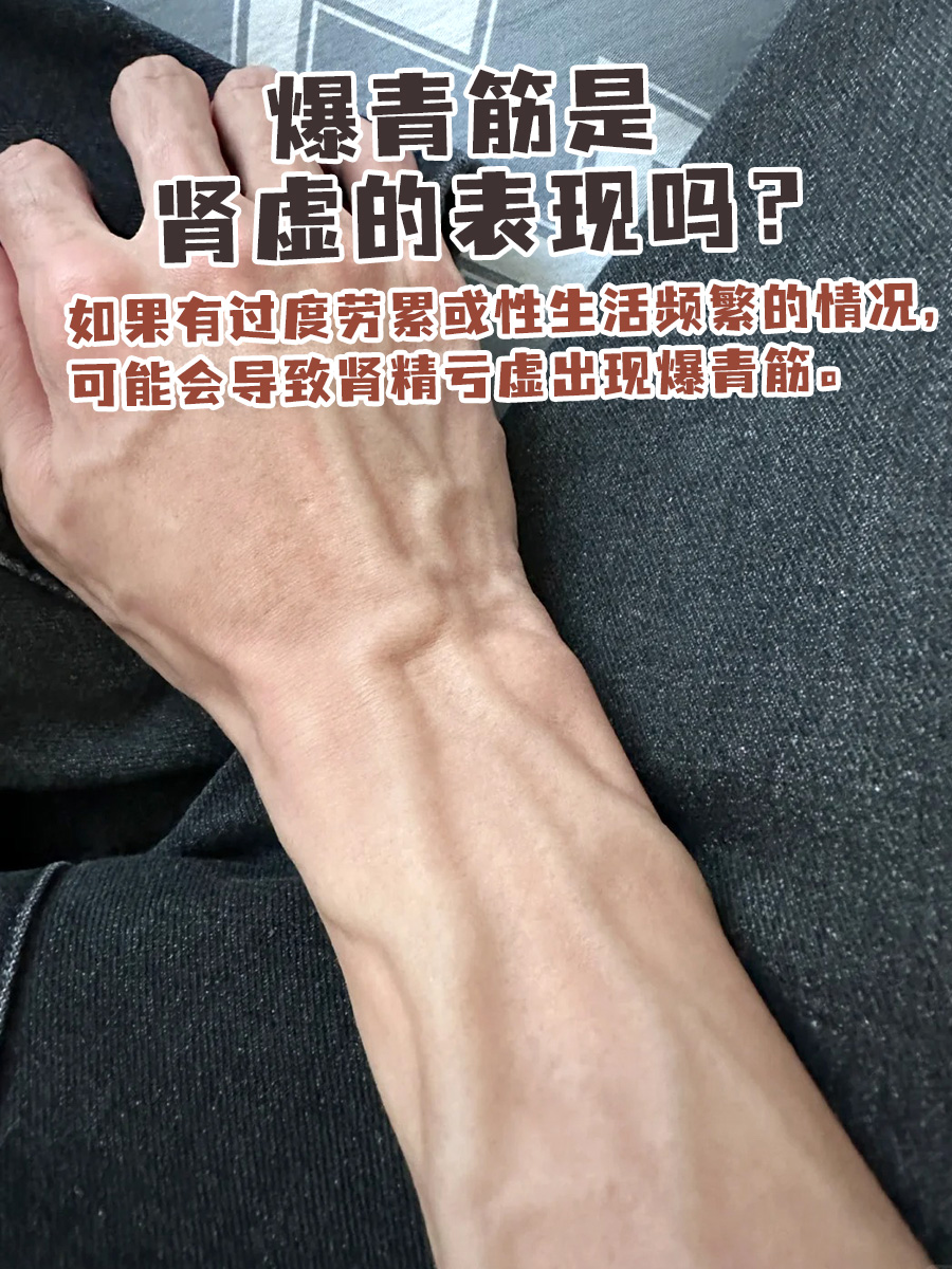 爆青筋是肾虚的表现吗？医生一文讲清！