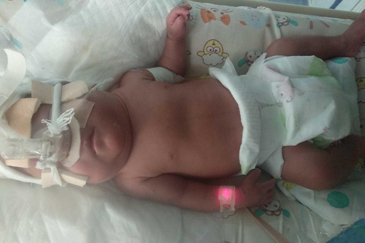 软骨发育不良婴儿图 软骨发育不良婴儿图