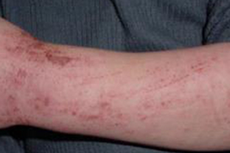 革螨皮炎胳膊抓破结痂图