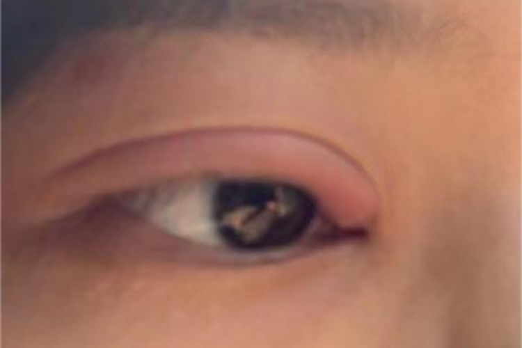 泪腺炎上眼皮红肿图