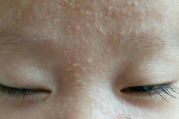 新生儿鼻子上长白色的小米粒图片 本文由有来医生原创,经专业医师审核