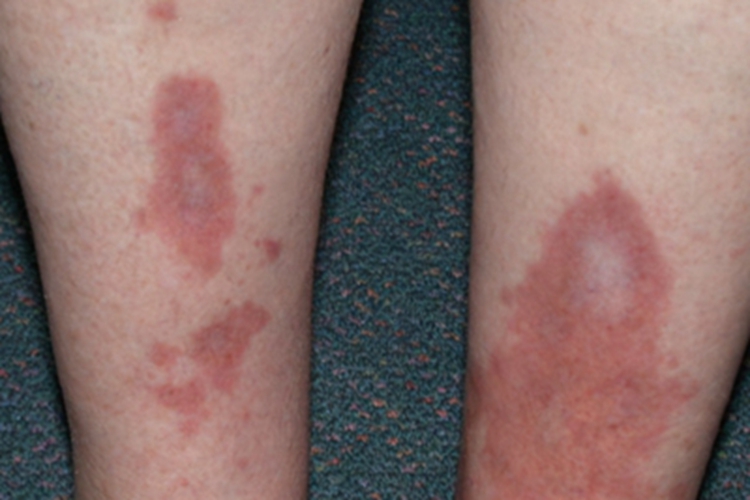 费尔蒂综合征小腿上有大片红斑图 费尔蒂综合征小腿上有大片红斑图